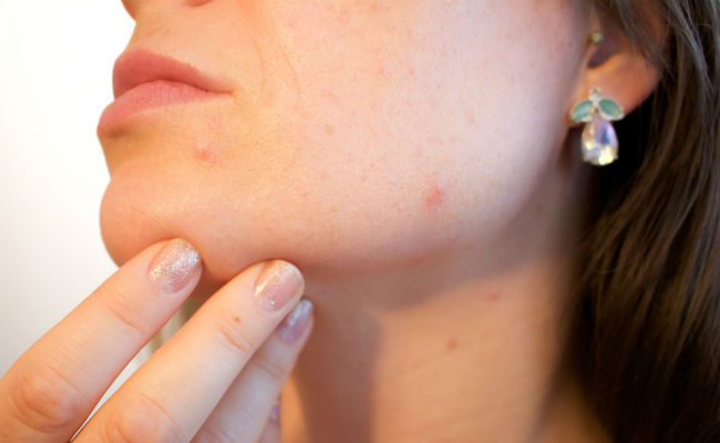 skin-types-and-acne